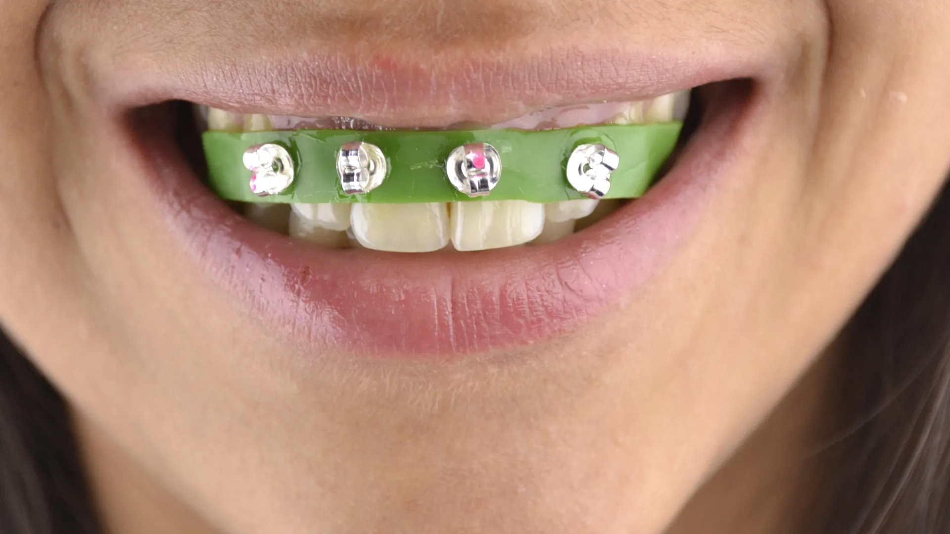 Smiling person with green braces adorned with decorative gems.