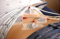 Medical sensors attached to a patient's lower back.